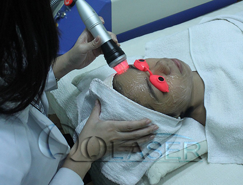 Cong nghe laser acnes