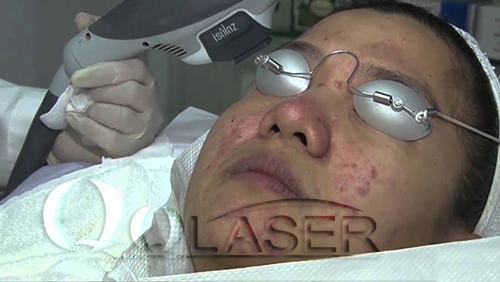May laser acnes tri mun