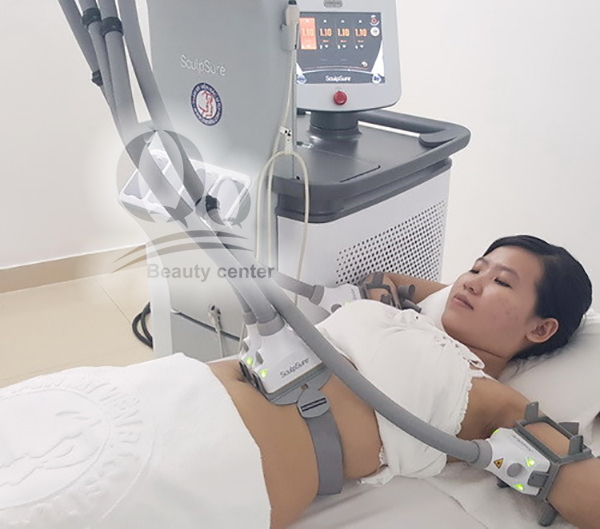 cong nghe giam beo laser schulpsure
