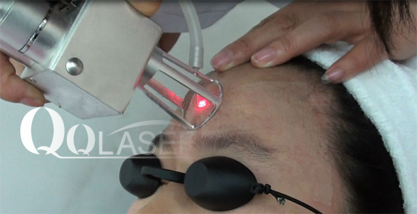 laser 2 acupules